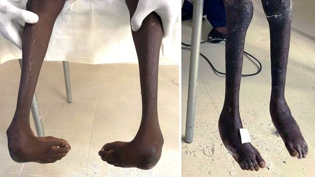 Serigne's feet before and after the treatment